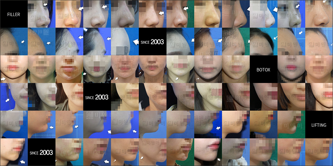 SINCE 2003 MI&MI, 시술후사진모음 영등포잡티,영등포역잡티,영등포주근깨,영등포역주근깨,영등포기미,영등포역기미,영등포색소,영등포역색소,영등포레이저토닝,영등포역레이저토닝,영등포IPL,영등포역IPL,영등포엔디야그,영등포역엔디야그,영등포바이탈이온트,영등포역바이탈이온트,영등포롱펄스레이저,영등포역롱펄스레이저